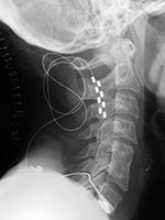 Dorsal column stimulator in upper cervical spine